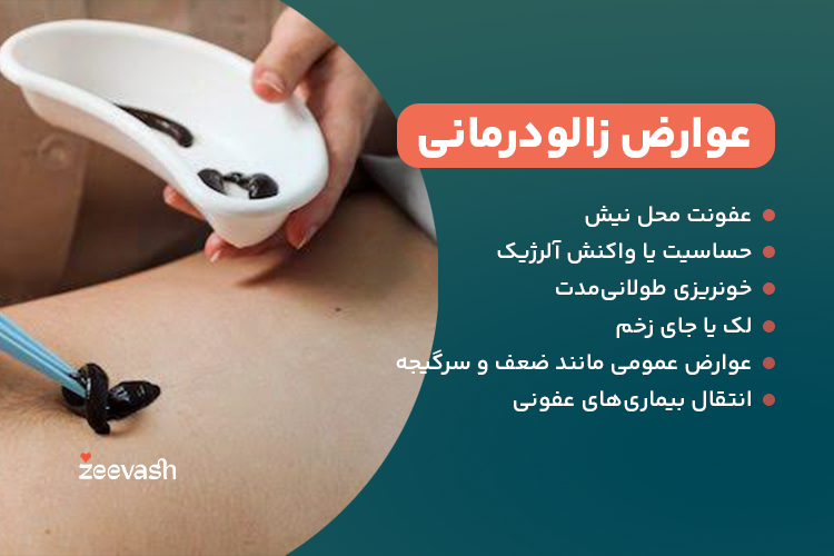 عوارض زالودرمانی